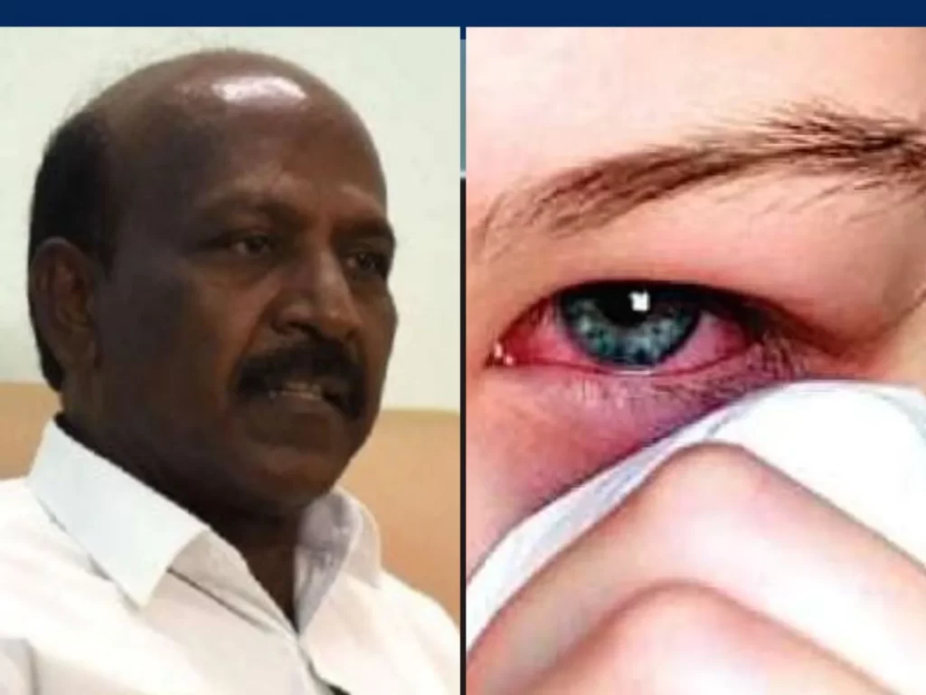 There is no need to fear against Madras eye